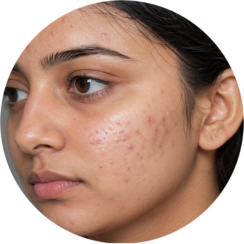 Acne Prone Skin - Glamline