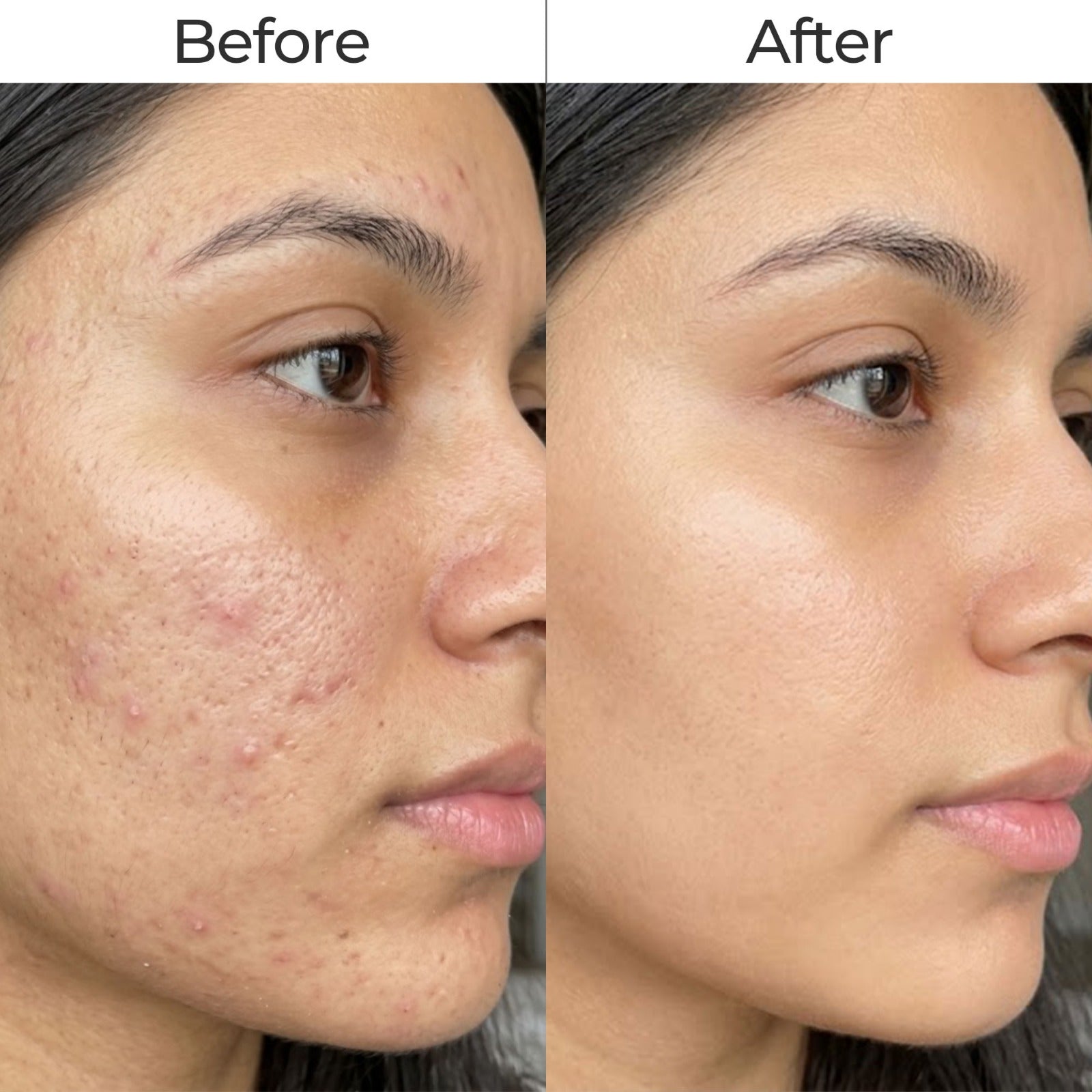 Formulated for acne-prone and oily skin
