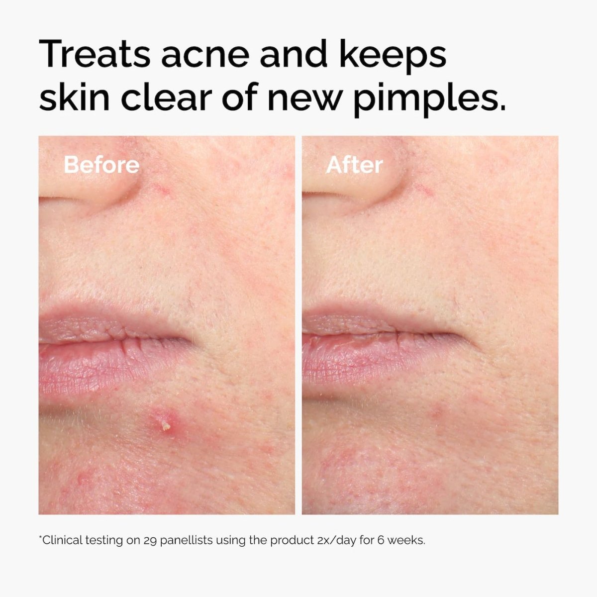 Anti Acne Serum Boosted with Salicylic Acid - Glamline